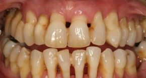 Пародонтоз - заболевание зубов и десен
