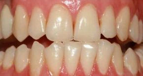 Гингивит - болезнь зубов и полости рта